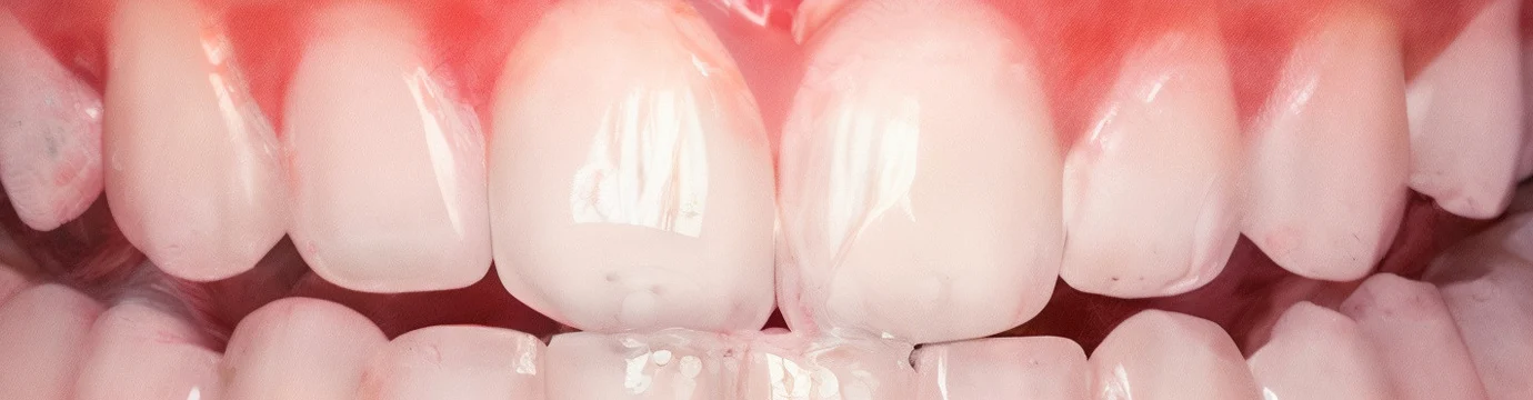 The same teeth after whitening treatment